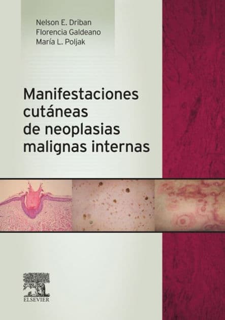 Manifestaciones cutáneas de neoplasias malignas internas by Nelson Edgardo Driban