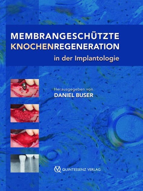 Membrangeschützte Knochenregeneration in der Implantologie by Daniel Buser