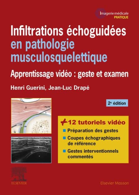 Infiltrations échoguidées en pathologie musculosquelettique: Apprentissage vidéo : geste et examen by Jean-Luc Drapé