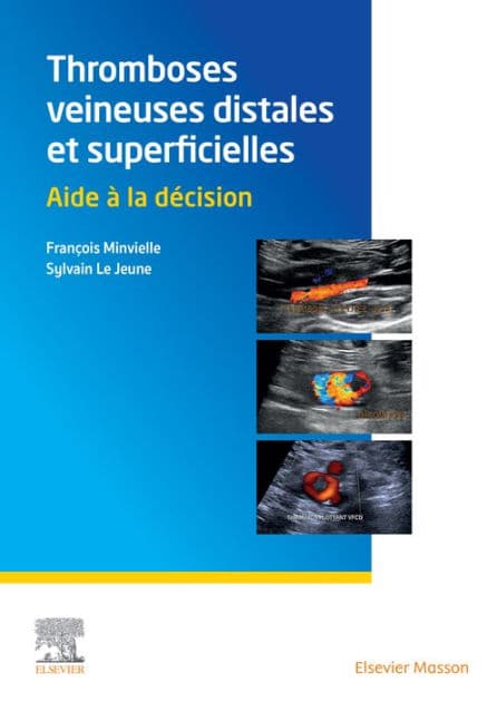 Thromboses veineuses distales et superficielles: Aide à la décision by François Minvielle