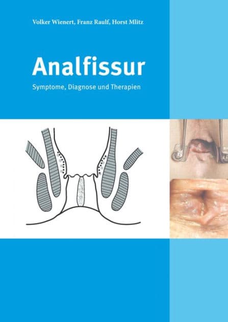 Analfissur: Symptome, Diagnose und Therapien by Franz Raulf