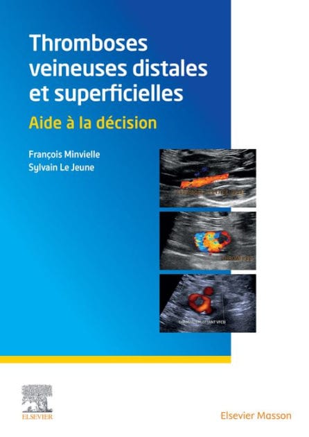 Thromboses veineuses distales et superficielles: Aide à la décision